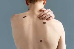 악성 흑색종 melanoma