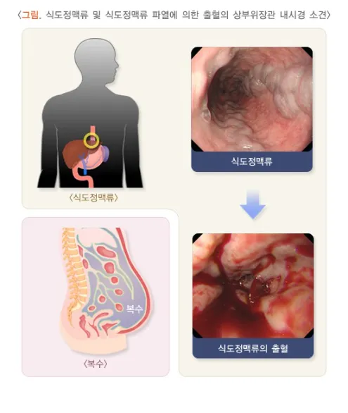 알코올성 간질환의 증상
