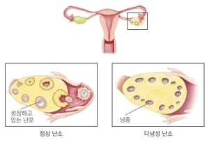 다낭성 난소 증후군